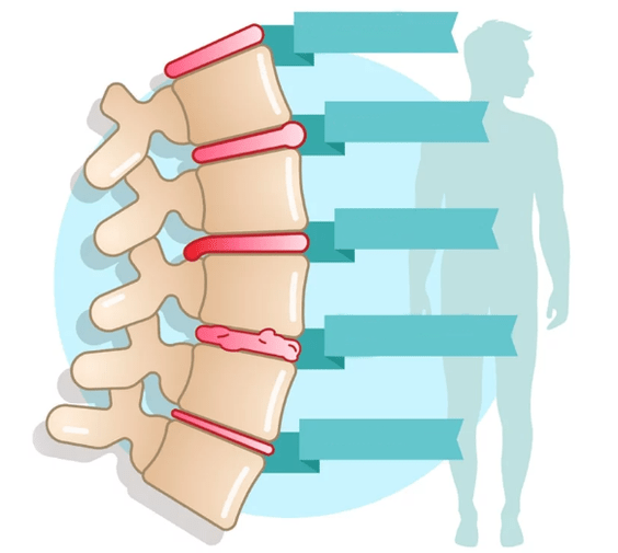 Stupeň onemocnění hrudní osteochondrosy