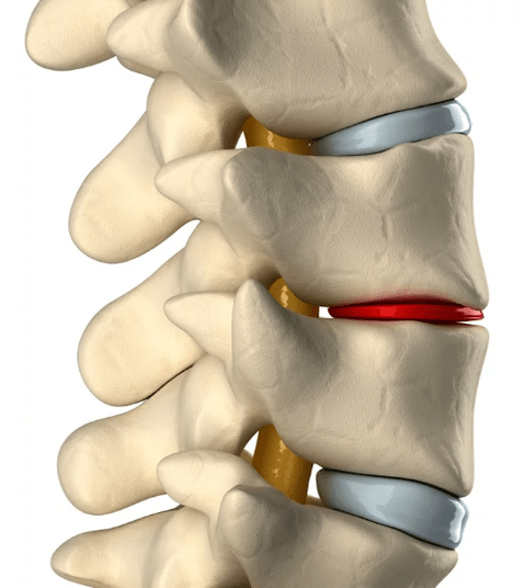 osteochondroza hrudní páteře