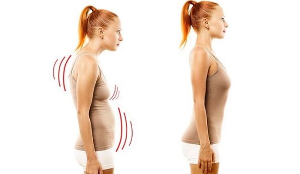 rovná záda a špatné držení těla s cervikální osteochondrózou