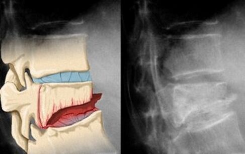 Trhliny v meziobratlových ploténách v první fázi cervikální osteochondrózy