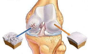 zdravé chrupavky a artróza kolenního kloubu